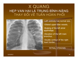6/19/2013 54
X QUANG
HEÏP VAN HAI LAÙ TRUNG BÌNH-NAËNG
THAY ÑOÅI VEÀ TUAÀN HOAØN PHOÅI
-Left ventricle has normal size.
-Dilated upper lobe vessels.
-Bulging of the left atrial
appendage.
-Elevation of the left main
bronchus.
-Double contour of the right
heart border.
MITRAL STENOSIS
 