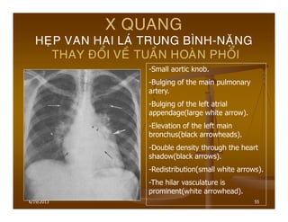 6/19/2013 55
X QUANG
HEÏP VAN HAI LAÙ TRUNG BÌNH-NAËNG
THAY ÑOÅI VEÀ TUAÀN HOAØN PHOÅI
-Small aortic knob.
-Bulging of the main pulmonary
artery.
-Bulging of the left atrial
appendage(large white arrow).
-Elevation of the left main
bronchus(black arrowheads).
-Double density through the heart
shadow(black arrows).
-Redistribution(small white arrows).
-The hilar vasculature is
prominent(white arrowhead).
 