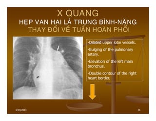 6/19/2013 56
X QUANG
HEÏP VAN HAI LAÙ TRUNG BÌNH-NAËNG
THAY ÑOÅI VEÀ TUAÀN HOAØN PHOÅI
-Dilated upper lobe vessels.
-Bulging of the pulmonary
artery.
-Elevation of the left main
bronchus.
-Double contour of the right
heart border.
 