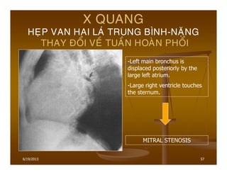 6/19/2013 57
X QUANG
HEÏP VAN HAI LAÙ TRUNG BÌNH-NAËNG
THAY ÑOÅI VEÀ TUAÀN HOAØN PHOÅI
-Left main bronchus is
displaced posteriorly by the
large left atrium.
-Large right ventricle touches
the sternum.
MITRAL STENOSIS
 