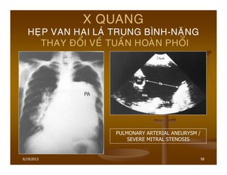 6/19/2013 58
X QUANG
HEÏP VAN HAI LAÙ TRUNG BÌNH-NAËNG
THAY ÑOÅI VEÀ TUAÀN HOAØN PHOÅI
PULMONARY ARTERIAL ANEURYSM /
SEVERE MITRAL STENOSIS
 