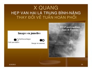 6/19/2013 59
X QUANG
HEÏP VAN HAI LAÙ TRUNG BÌNH-NAËNG
THAY ÑOÅI VEÀ TUAÀN HOAØN PHOÅI
 