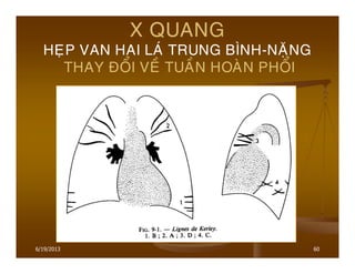 6/19/2013 60
X QUANG
HEÏP VAN HAI LAÙ TRUNG BÌNH-NAËNG
THAY ÑOÅI VEÀ TUAÀN HOAØN PHOÅI
 
