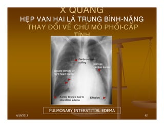 6/19/2013 62
X QUANG
HEÏP VAN HAI LAÙ TRUNG BÌNH-NAËNG
THAY ÑOÅI VEÀ CHUÛ MOÂ PHOÅI-CAÁP
TÍNH
PULMONARY INTERSTITIAL EDEMA
 