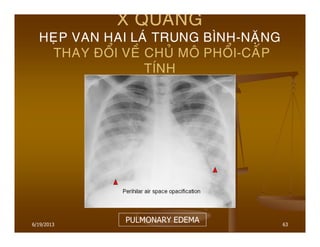 6/19/2013 63
X QUANG
HEÏP VAN HAI LAÙ TRUNG BÌNH-NAËNG
THAY ÑOÅI VEÀ CHUÛ MOÂ PHOÅI-CAÁP
TÍNH
PULMONARY EDEMA
 