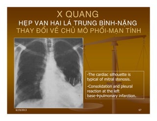6/19/2013 67
X QUANG
HEÏP VAN HAI LAÙ TRUNG BÌNH-NAËNG
THAY ÑOÅI VEÀ CHUÛ MOÂ PHOÅI-MAÏN TÍNH
-The cardiac silhouette is
typical of mitral stenosis.
-Consolidation and pleural
reaction at the left
base pulmonary infarction.
 