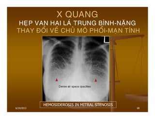 6/19/2013 68
X QUANG
HEÏP VAN HAI LAÙ TRUNG BÌNH-NAËNG
THAY ÑOÅI VEÀ CHUÛ MOÂ PHOÅI-MAÏN TÍNH
HEMOSIDEROSIS IN MITRAL STENOSIS
 