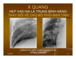 6/19/2013 69
X QUANG
HEÏP VAN HAI LAÙ TRUNG BÌNH-NAËNG
THAY ÑOÅI VEÀ CHUÛ MOÂ PHOÅI-MAÏN TÍNH
KERLEY’S B LINES & HEMOSIDEROSIS IN
MITRAL STENOSIS
 