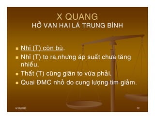 6/19/2013 72
X QUANG
HÔÛ VAN HAI LAÙ TRUNG BÌNH
Nhó (T) coøn buø.
Nhó (T) to ra,nhöng aùp suaát chöa taêng
nhieàu.
Thaát (T) cuõng giaõn to vöøa phaûi.
Quai ÑMC nhoû do cung löôïng tim giaûm.
 