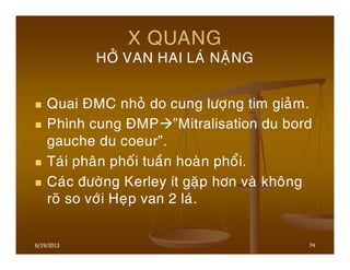 6/19/2013 74
X QUANG
HÔÛ VAN HAI LAÙ NAËNG
Quai ÑMC nhoû do cung löôïng tim giaûm.
Phình cung ÑMP ”Mitralisation du bord
gauche du coeur”.
Taùi phaân phoái tuaàn hoaøn phoåi.
Caùc ñöôøng Kerley ít gaëp hôn vaø khoâng
roõ so vôùi Heïp van 2 laù.
 