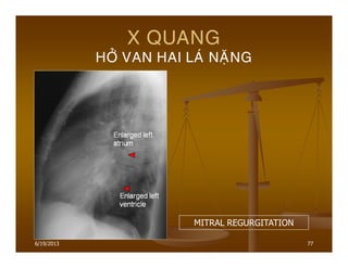 6/19/2013 77
X QUANG
HÔÛ VAN HAI LAÙ NAËNG
MITRAL REGURGITATION
 