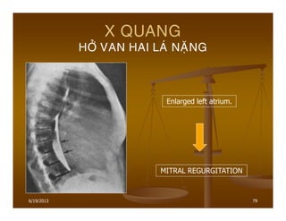 6/19/2013 79
X QUANG
HÔÛ VAN HAI LAÙ NAËNG
Enlarged left atrium.
MITRAL REGURGITATION
 