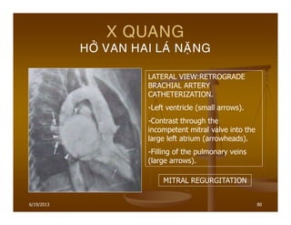 6/19/2013 80
X QUANG
HÔÛ VAN HAI LAÙ NAËNG
LATERAL VIEW:RETROGRADE
BRACHIAL ARTERY
CATHETERIZATION.
-Left ventricle (small arrows).
-Contrast through the
incompetent mitral valve into the
large left atrium (arrowheads).
-Filling of the pulmonary veins
(large arrows).
MITRAL REGURGITATION
 