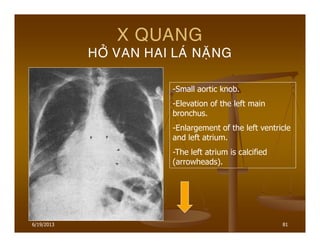 6/19/2013 81
X QUANG
HÔÛ VAN HAI LAÙ NAËNG
-Small aortic knob.
-Elevation of the left main
bronchus.
-Enlargement of the left ventricle
and left atrium.
-The left atrium is calcified
(arrowheads).
 