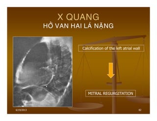 6/19/2013 82
X QUANG
HÔÛ VAN HAI LAÙ NAËNG
Calcification of the left atrial wall
MITRAL REGURGITATION
 