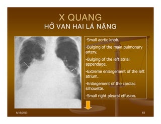 6/19/2013 83
X QUANG
HÔÛ VAN HAI LAÙ NAËNG
-Small aortic knob.
-Bulging of the main pulmonary
artery.
-Bulging of the left atrial
appendage.
-Extreme enlargement of the left
atrium.
-Enlargement of the cardiac
silhouette.
-Small right pleural effusion.
 
