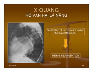 6/19/2013 84
X QUANG
HÔÛ VAN HAI LAÙ NAËNG
Calcification of the posterior wall of
the huge left atrium.
MITRAL REGURGITATION
 