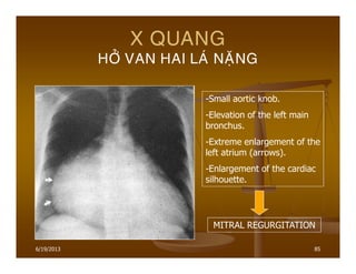 6/19/2013 85
X QUANG
HÔÛ VAN HAI LAÙ NAËNG
MITRAL REGURGITATION
-Small aortic knob.
-Elevation of the left main
bronchus.
-Extreme enlargement of the
left atrium (arrows).
-Enlargement of the cardiac
silhouette.
 