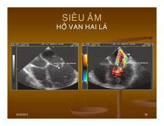 6/19/2013 86
SIEÂU AÂM
HÔÛ VAN HAI LAÙ
 