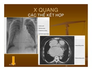 6/19/2013 89
X QUANG
CAÙC THEÅ KEÁT HÔÏP
 