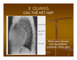 6/19/2013 90
X QUANG
CAÙC THEÅ KEÁT HÔÏP
Mitral valve stenosis
and regurgitation-
prosthetic mitral valve
 