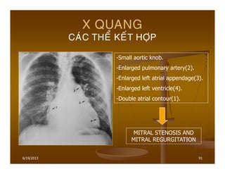 6/19/2013 91
X QUANG
CAÙC THEÅ KEÁT HÔÏP
MITRAL STENOSIS AND
MITRAL REGURGITATION
-Small aortic knob.
-Enlarged pulmonary artery(2).
-Enlarged left atrial appendage(3).
-Enlarged left ventricle(4).
-Double atrial contour(1).
 