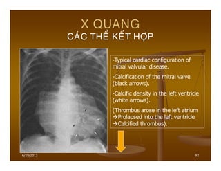 6/19/2013 92
X QUANG
CAÙC THEÅ KEÁT HÔÏP
-Typical cardiac configuration of
mitral valvular disease.
-Calcification of the mitral valve
(black arrows).
-Calcific density in the left ventricle
(white arrows).
(Thrombus arose in the left atrium
Prolapsed into the left ventricle
Calcified thrombus).
 