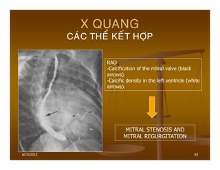 6/19/2013 93
X QUANG
CAÙC THEÅ KEÁT HÔÏP
RAO
-Calcification of the mitral valve (black
arrows).
-Calcific density in the left ventricle (white
arrows).
MITRAL STENOSIS AND
MITRAL REGURGITATION
 