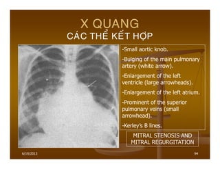 6/19/2013 94
X QUANG
CAÙC THEÅ KEÁT HÔÏP
-Small aortic knob.
-Bulging of the main pulmonary
artery (white arrow).
-Enlargement of the left
ventricle (large arrowheads).
-Enlargement of the left atrium.
-Prominent of the superior
pulmonary veins (small
arrowhead).
-Kerley’s B lines.
MITRAL STENOSIS AND
MITRAL REGURGITATION
 