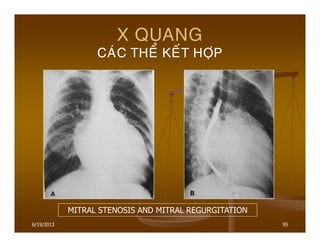 6/19/2013 95
X QUANG
CAÙC THEÅ KEÁT HÔÏP
MITRAL STENOSIS AND MITRAL REGURGITATION
 