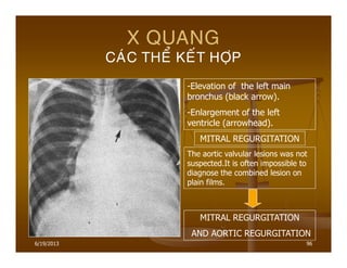 6/19/2013 96
X QUANG
CAÙC THEÅ KEÁT HÔÏP
-Elevation of the left main
bronchus (black arrow).
-Enlargement of the left
ventricle (arrowhead).
MITRAL REGURGITATION
The aortic valvular lesions was not
suspected.It is often impossible to
diagnose the combined lesion on
plain films.
MITRAL REGURGITATION
AND AORTIC REGURGITATION
 