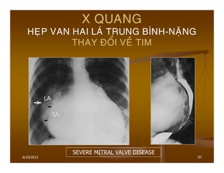 6/19/2013 97
X QUANG
HEÏP VAN HAI LAÙ TRUNG BÌNH-NAËNG
THAY ÑOÅI VEÀ TIM
SEVERE MITRAL VALVE DISEASE
 
