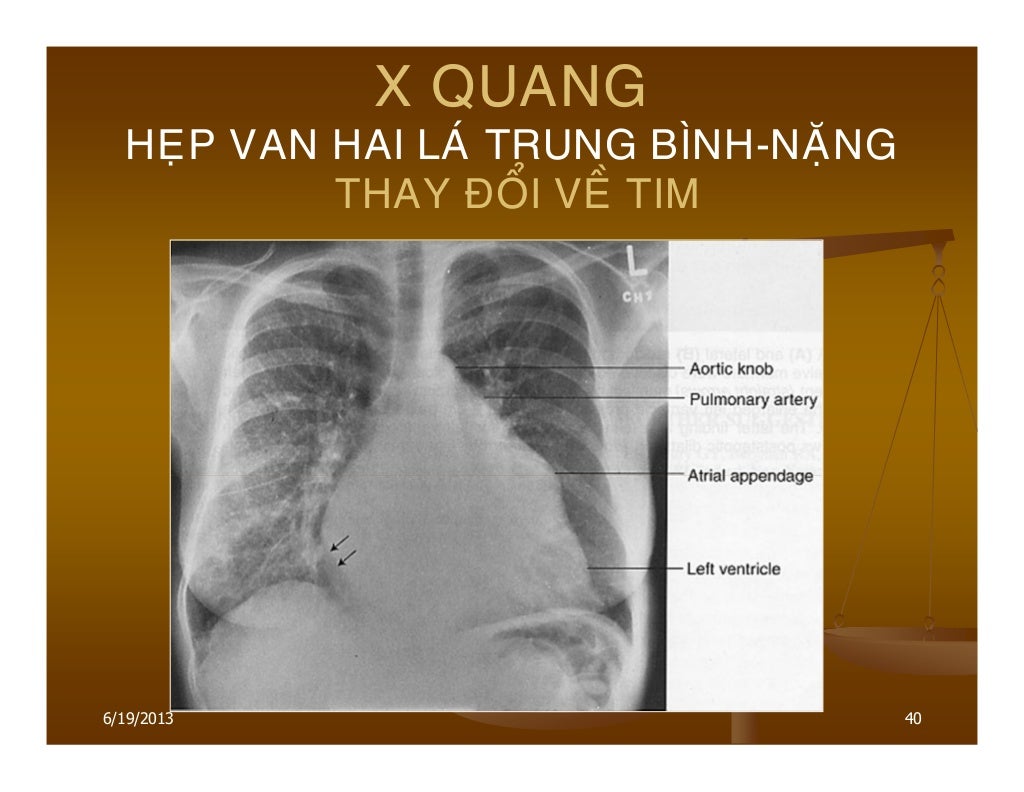 3.acquired valvular heart disease