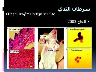 ‫الثدي‬ ‫سرطان‬
‫الحاج‬2003
‫ورم‬
‫ورم‬ ‫ال‬
CD44+ CD24low Lin- B38.1+ ESA+
 