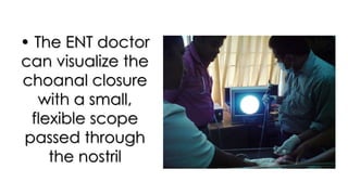 • The ENT doctor
can visualize the
choanal closure
with a small,
flexible scope
passed through
the nostril
 