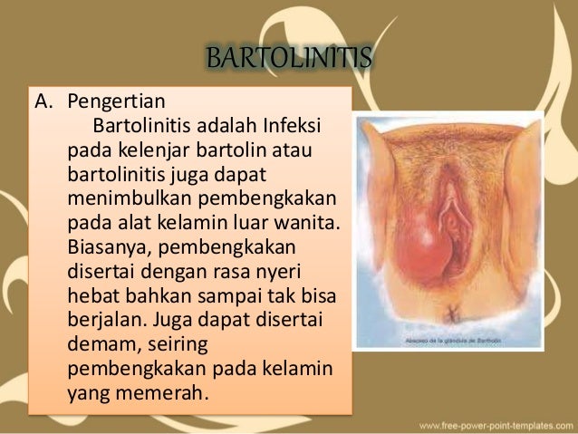 BARTOLINITIS ADALAH PDF