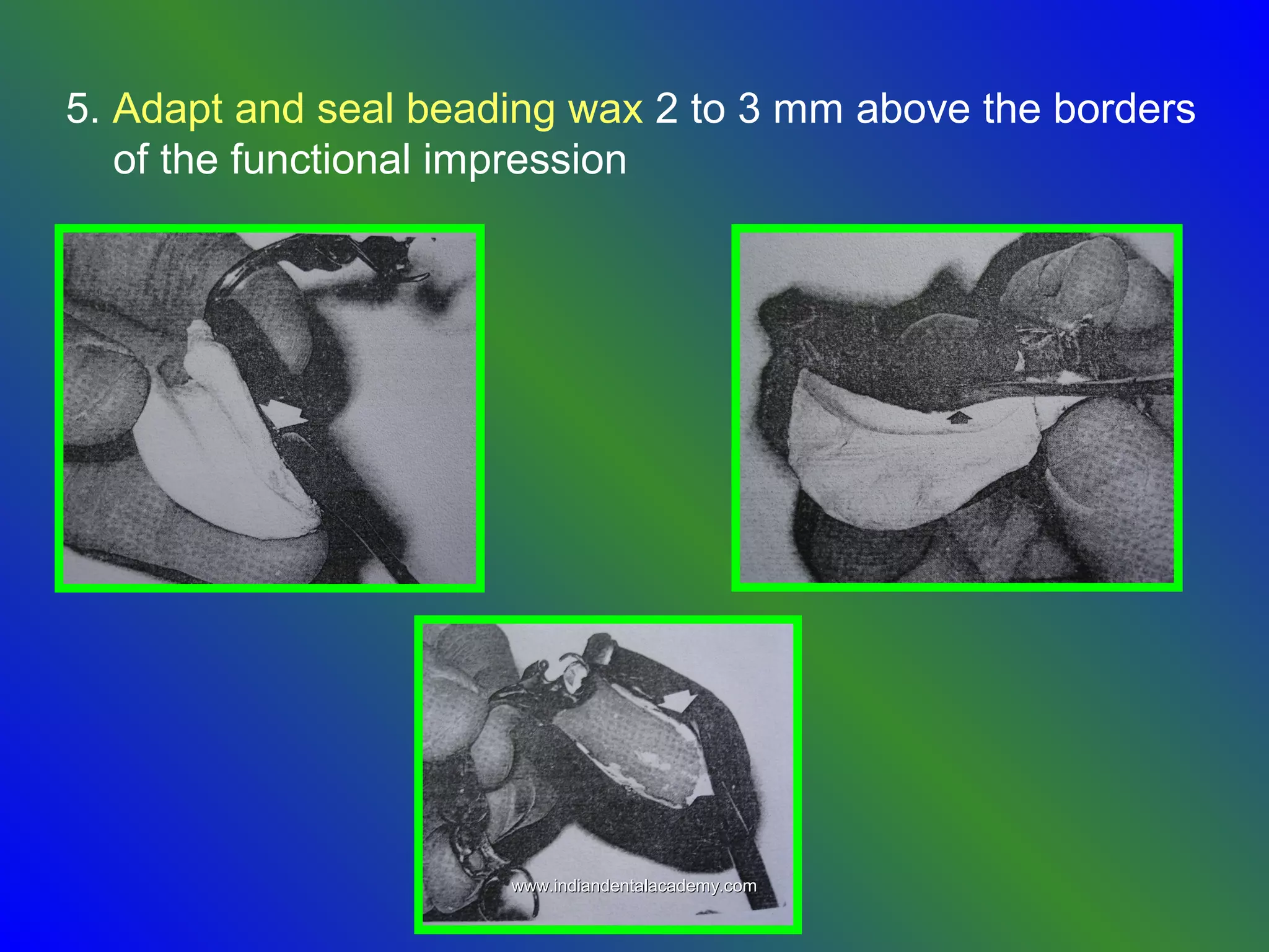 5. Adapt and seal beading wax 2 to 3 mm above the borders
of the functional impression
www.indiandentalacademy.comwww.indiandentalacademy.com
 