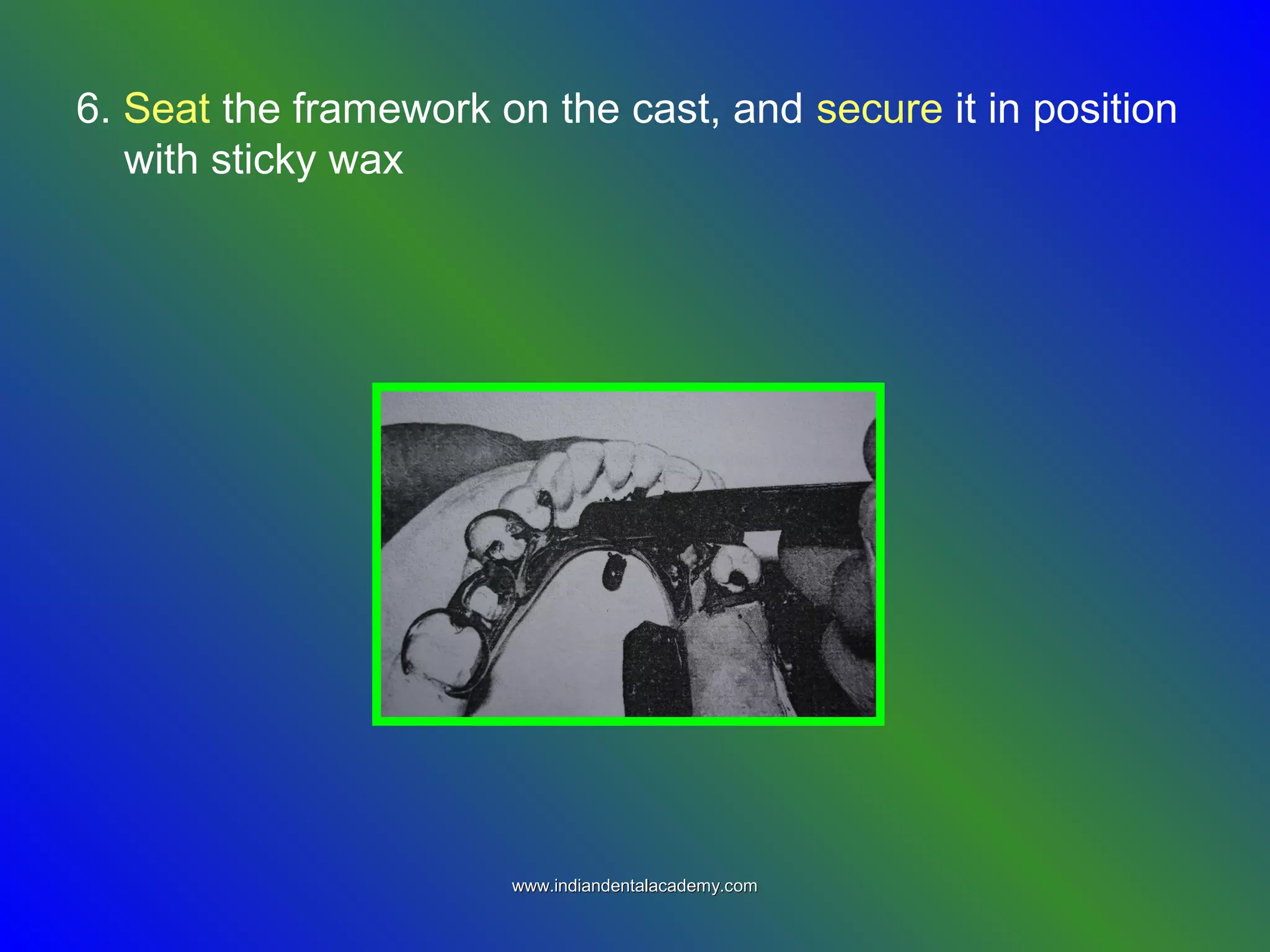 6. Seat the framework on the cast, and secure it in position
with sticky wax
www.indiandentalacademy.comwww.indiandentalacademy.com
 