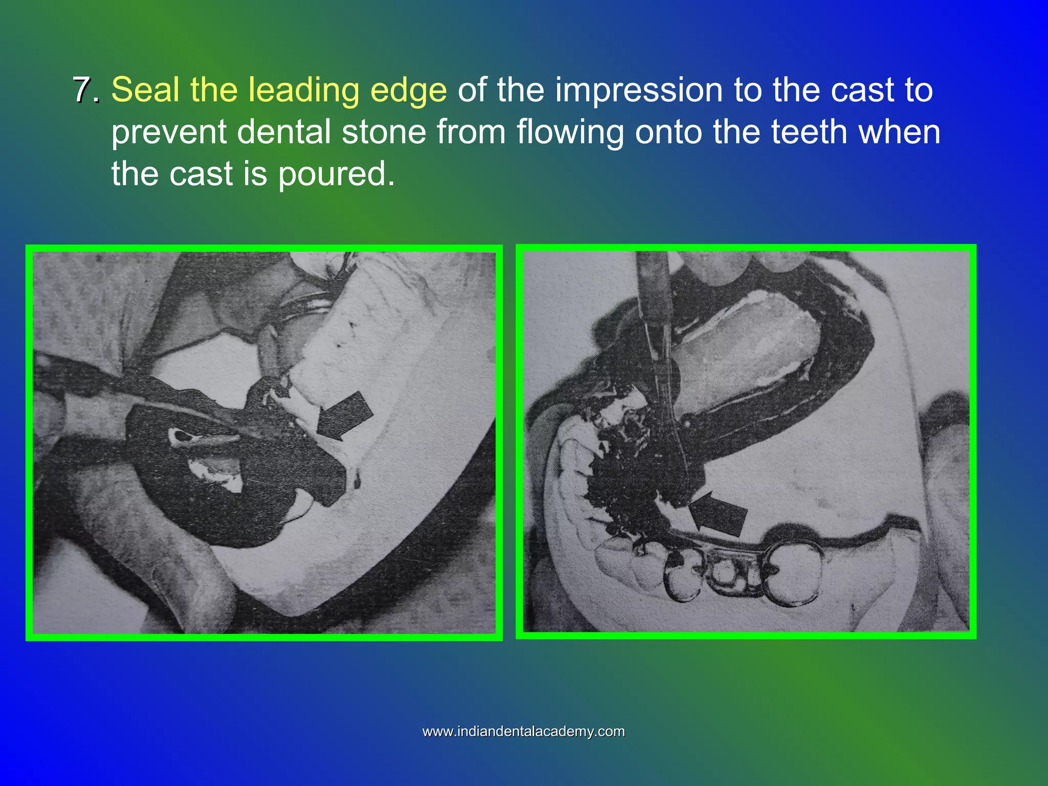 7.7. Seal the leading edge of the impression to the cast to
prevent dental stone from flowing onto the teeth when
the cast is poured.
www.indiandentalacademy.comwww.indiandentalacademy.com
 
