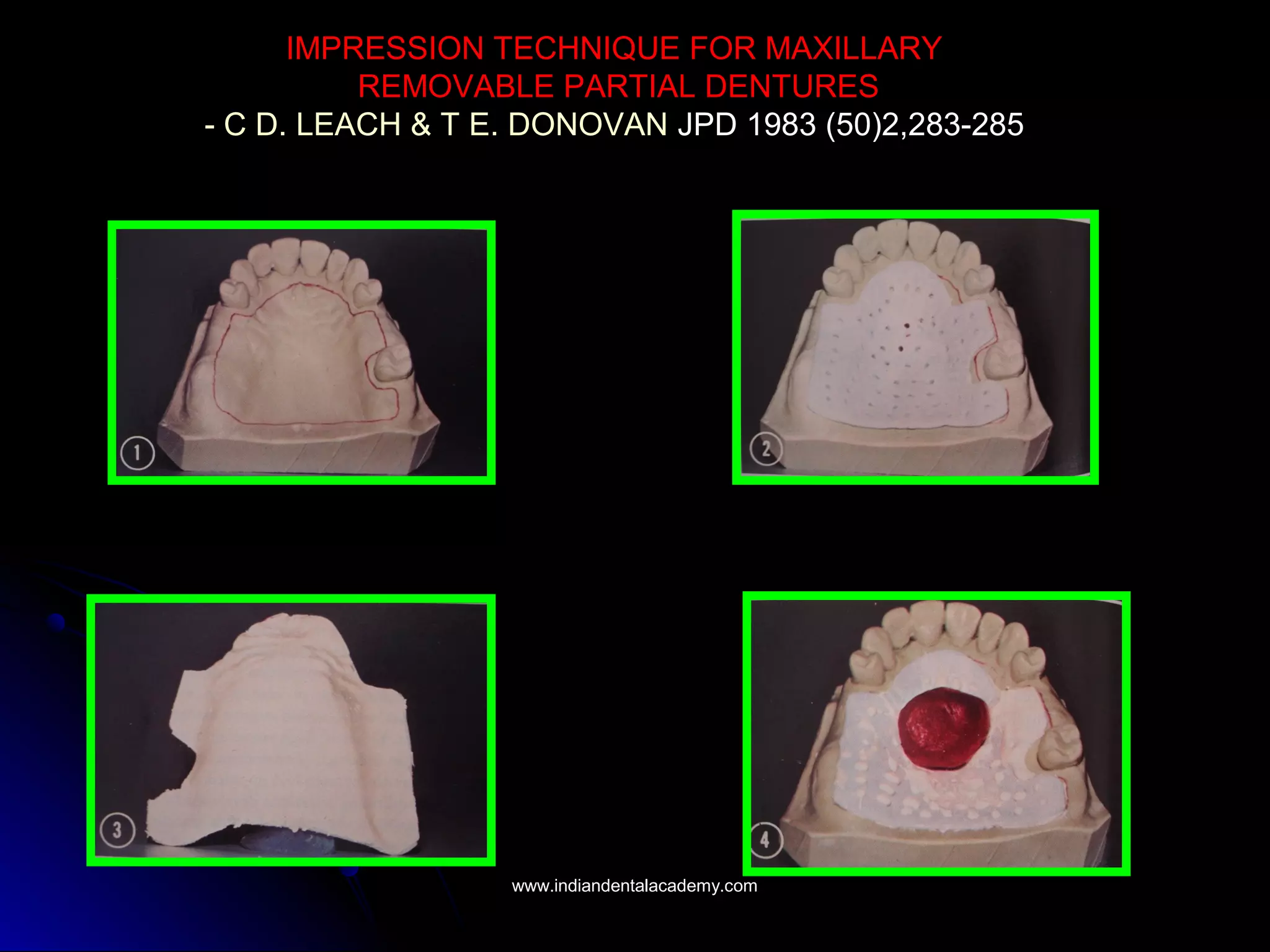 IMPRESSION TECHNIQUE FOR MAXILLARY
REMOVABLE PARTIAL DENTURES
- C D. LEACH & T E. DONOVAN JPD 1983 (50)2,283-285
www.indiandentalacademy.comwww.indiandentalacademy.com
 