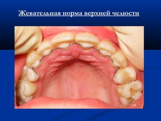 Жевательная норма верхней челюсти 
 