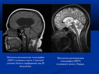 Магнитно-резонансная 
томография (МРТ) 
головного мозга. Норма. 
Магнитно-резонансная томография 
(МРТ) головного мозга. Стрелкой 
указана область перфорации дна III 
желудочка. 
 