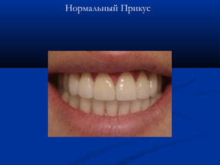 Нормальный Прикус 
 