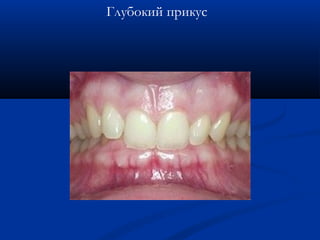 Глубокий прикус 
 