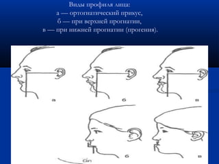 Виды профиля лица: 
а — ортогнатический прикус, 
б — при верхней прогнатии, 
в — при нижней прогнатии (прогения). 
 