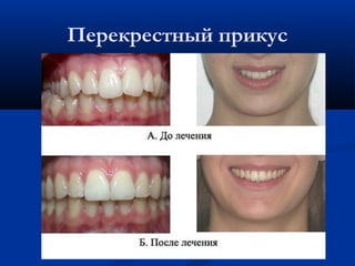 Перекрестный прикус 
 
