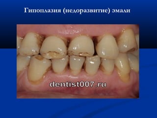 Гипоплазия (недоразвитие) эмали 
Гипоплазия эмали 
 