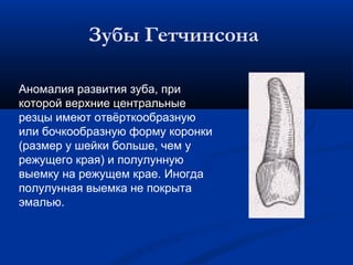 Зубы Гетчинсона 
Аномалия развития зуба, при 
которой верхние центральные 
резцы имеют отвёрткообразную 
или бочкообразную форму коронки 
(размер у шейки больше, чем у 
режущего края) и полулунную 
выемку на режущем крае. Иногда 
полулунная выемка не покрыта 
эмалью. 
 