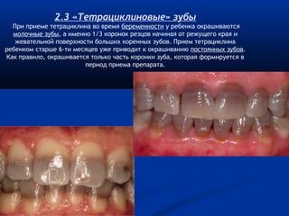 2.3 «Тетрациклиновые» зубы 
При приеме тетрациклина во время беременности у ребенка окрашиваются 
молочные зубы, а именно 1/3 коронок резцов начиная от режущего края и 
жевательной поверхности больших коренных зубов. Прием тетрациклина 
ребенком старше 6-ти месяцев уже приводит к окрашиванию постоянных зубов. 
Как правило, окрашивается только часть коронки зуба, которая формируется в 
период приема препарата. 
 