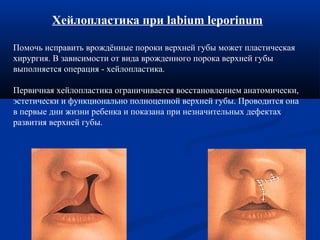 Хейлопластика при labium leporinum 
Помочь исправить врождённые пороки верхней губы может пластическая 
хирургия. В зависимости от вида врожденного порока верхней губы 
выполняется операция - хейлопластика. 
Первичная хейлопластика ограничивается восстановлением анатомически, 
эстетически и функционально полноценной верхней губы. Проводится она 
в первые дни жизни ребенка и показана при незначительных дефектах 
развития верхней губы. 
 